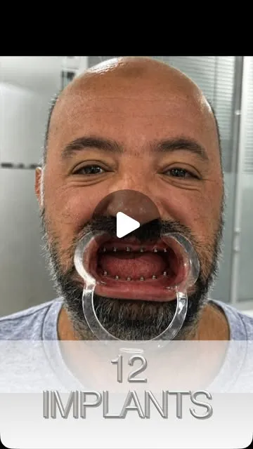 12 implants, de la planification numérique au sourire définitif