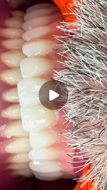 All-on-5 : 5 implants et un bridge fixe