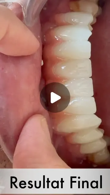Bridge inférieur sur implants