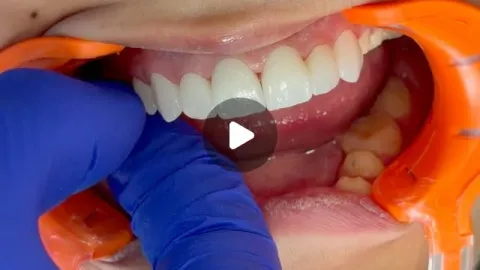Hollywood Smile : l'essayage du provisoire