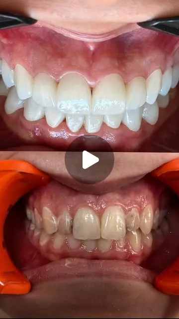 Hollywood Smile, fabriqué dans notre laboratoire intégré