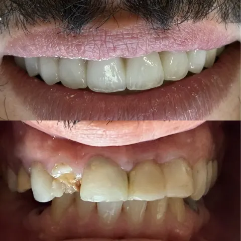 Cas réel Hollywood Smile — avant / après