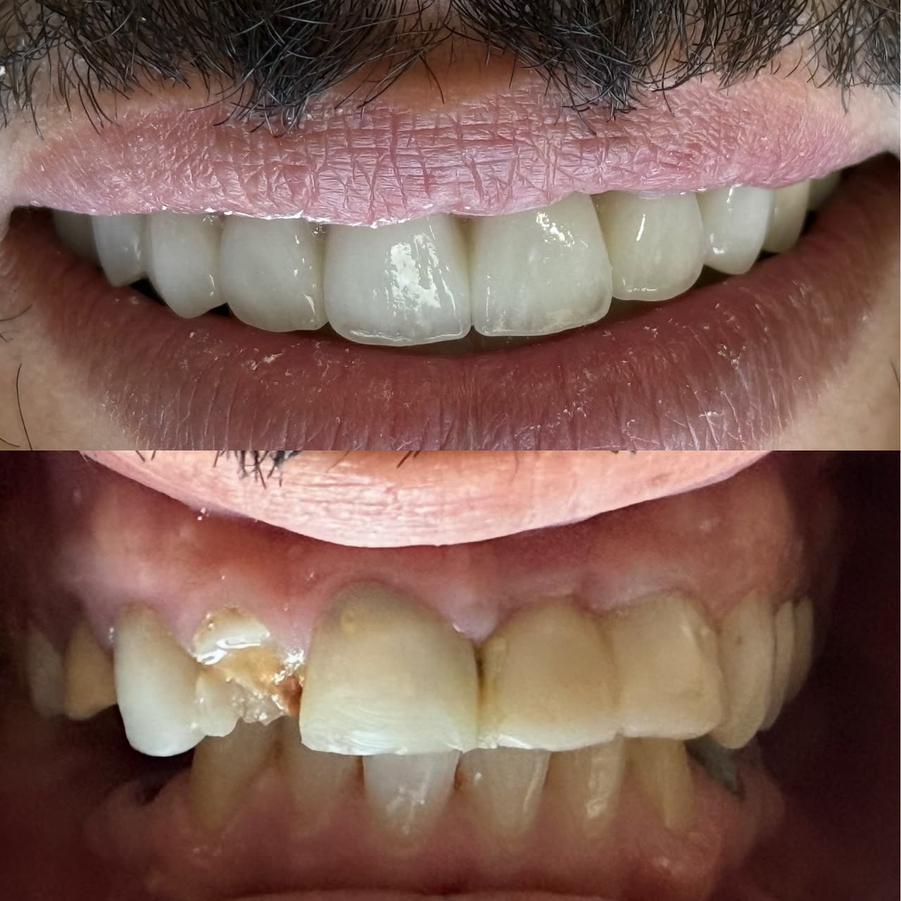 Cas réel Hollywood Smile — avant / après