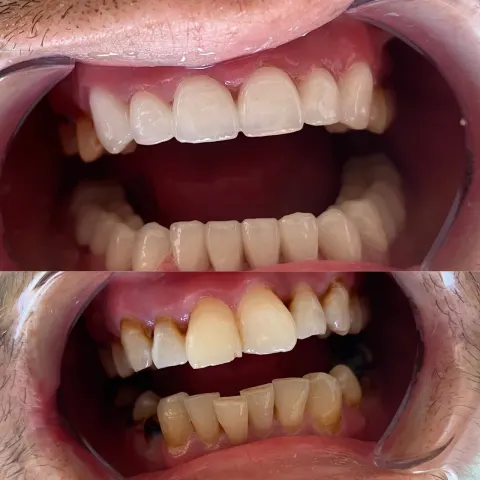 Cas réel Hollywood Smile — avant / après