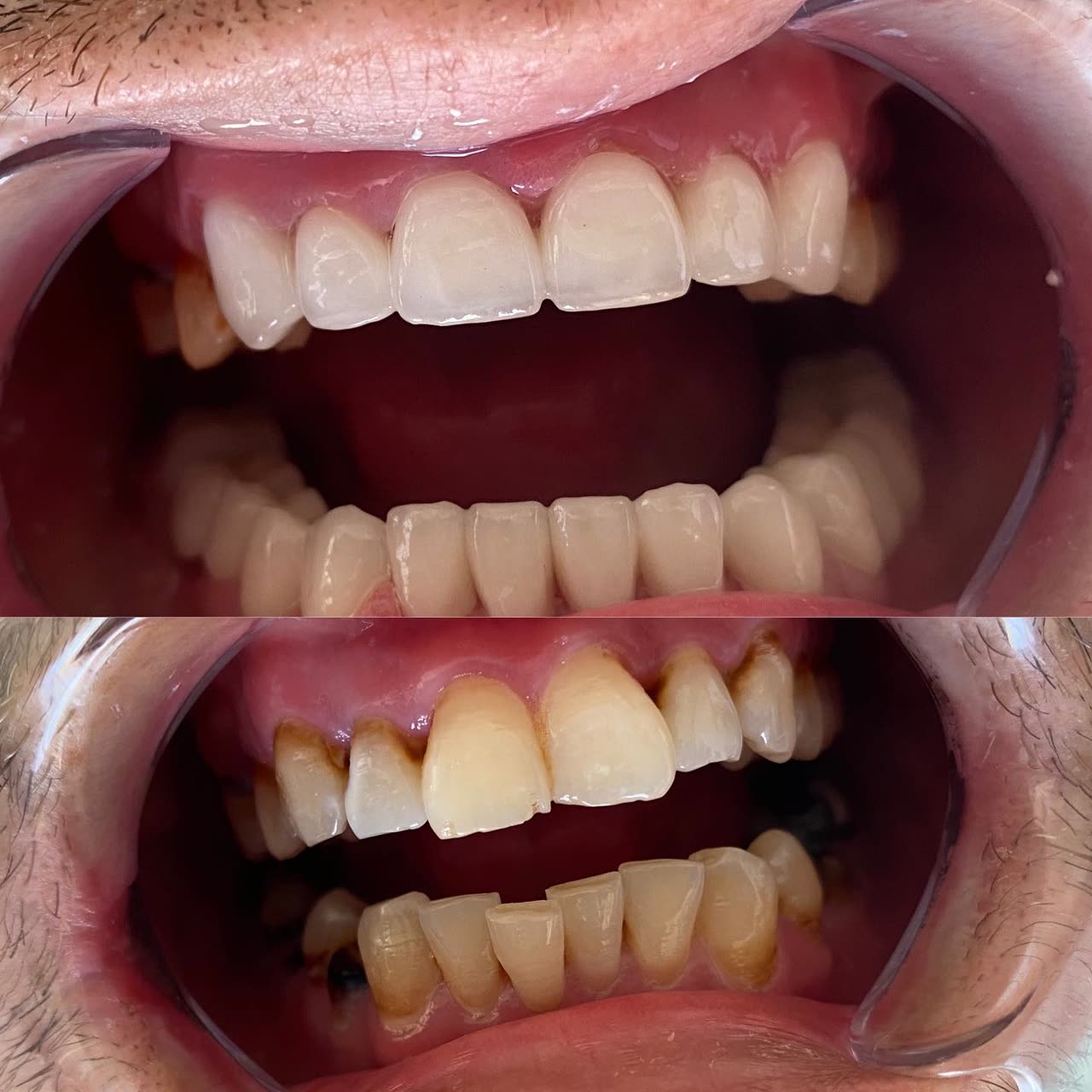 Cas réel Hollywood Smile — avant / après