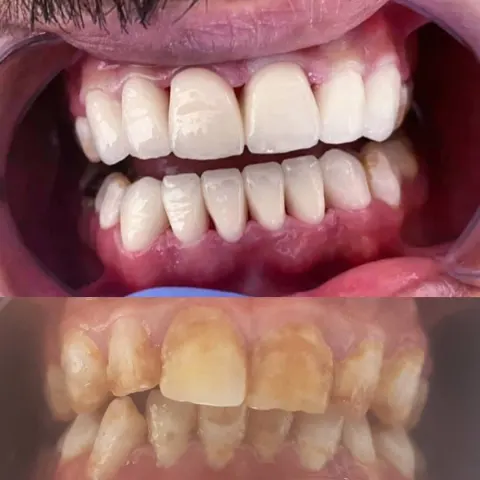Cas réel Hollywood Smile — avant / après
