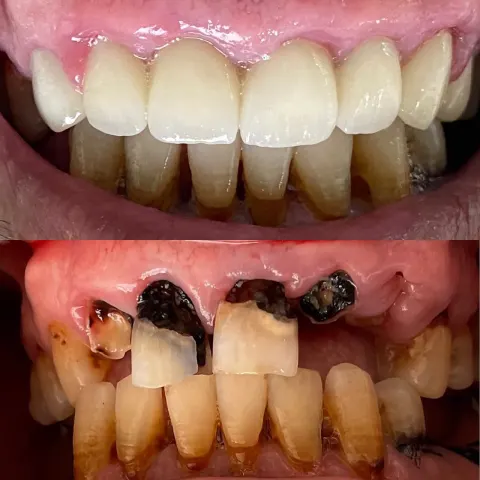 Cas réel Hollywood Smile — avant / après