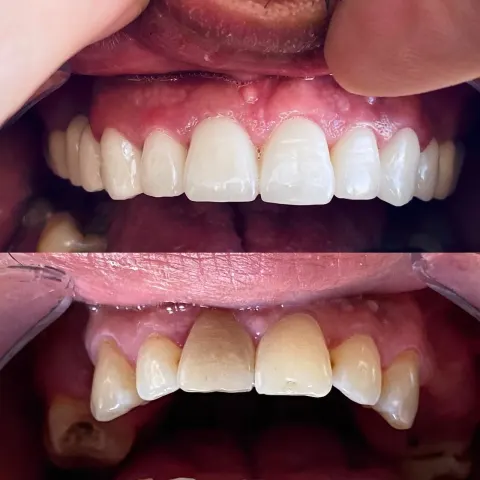 Cas réel Hollywood Smile — avant / après