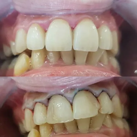 Cas réel Hollywood Smile — avant / après