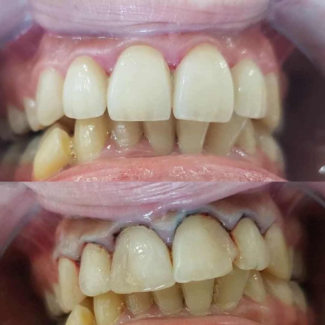 Cas réel Hollywood Smile — avant / après