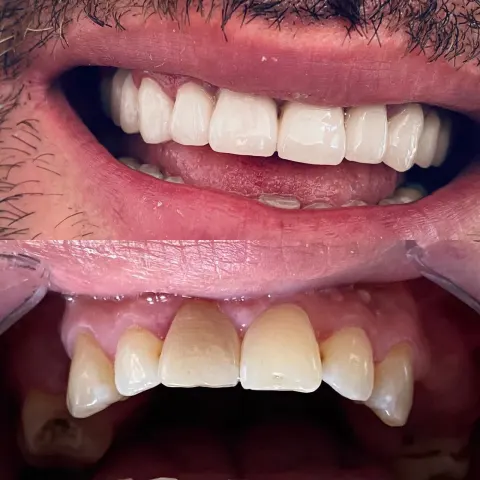Cas réel Hollywood Smile — avant / après