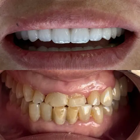 Cas réel Hollywood Smile — avant / après