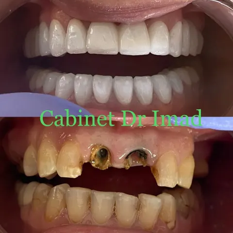 Cas réel Hollywood Smile — avant / après