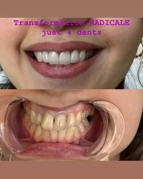 Cas réel Hollywood Smile — avant / après