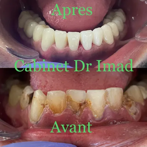 Cas réel Hollywood Smile — avant / après