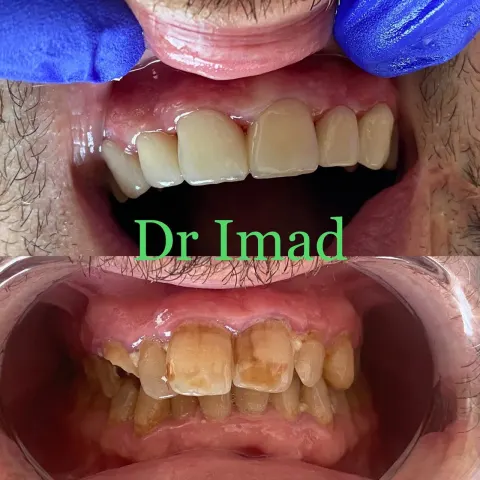 Cas réel Hollywood Smile — avant / après