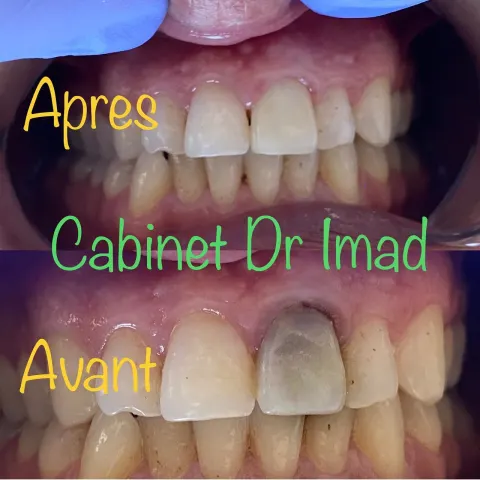 Cas réel Hollywood Smile — avant / après