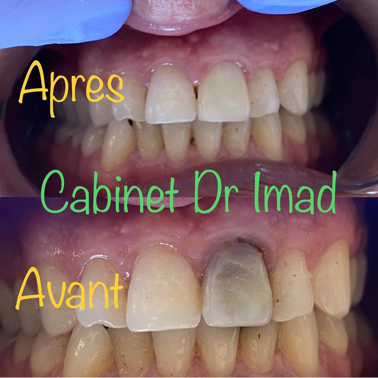 Cas réel Hollywood Smile — avant / après