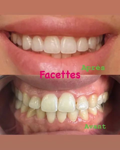 Cas réel Hollywood Smile — avant / après
