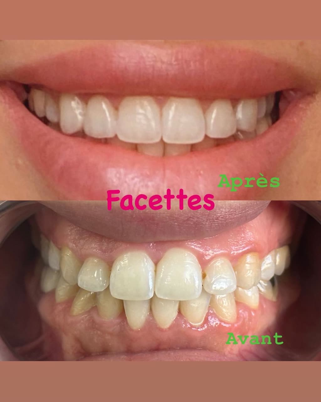 Cas réel Hollywood Smile — avant / après
