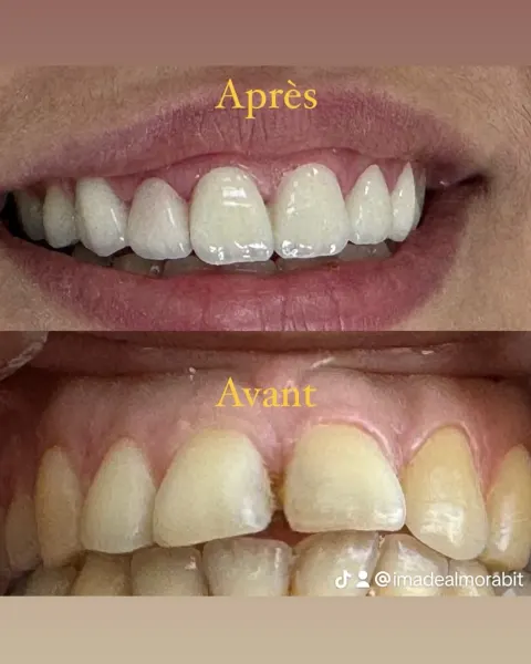 Cas réel Hollywood Smile — avant / après