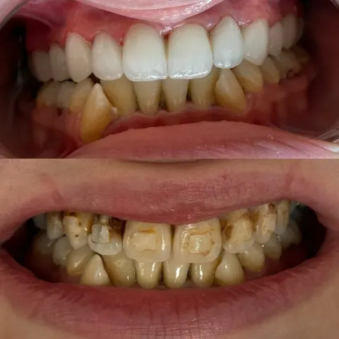 Cas réel Hollywood Smile — avant / après