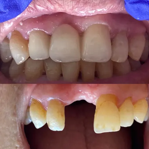 Cas réel Hollywood Smile — avant / après