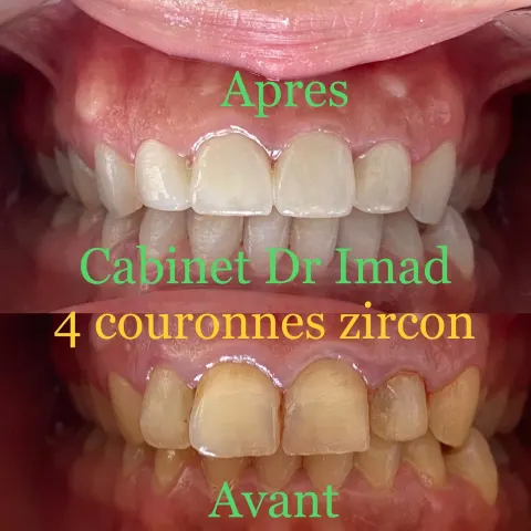 Cas réel Hollywood Smile — avant / après
