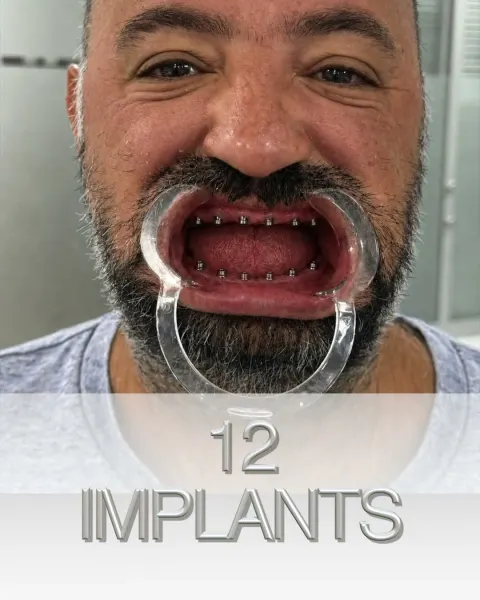 Cas réel : réhabilitation complète des deux mâchoires sur 12 implants, en vidéo