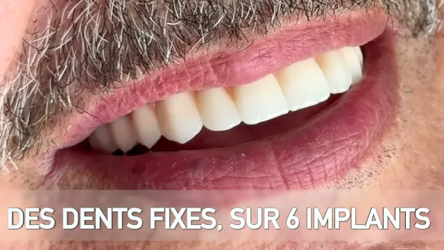 Cas réel All-on-6 : 6 implants et bridge fixe vissé, en vidéo