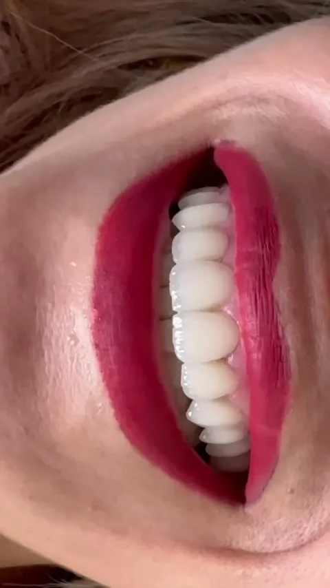 Cas réel Hollywood Smile en vidéo