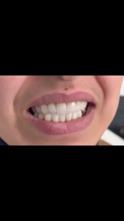 Cas réel Hollywood Smile en vidéo