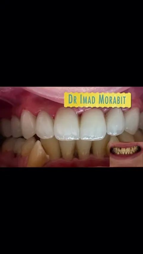 Cas réel Hollywood Smile en vidéo