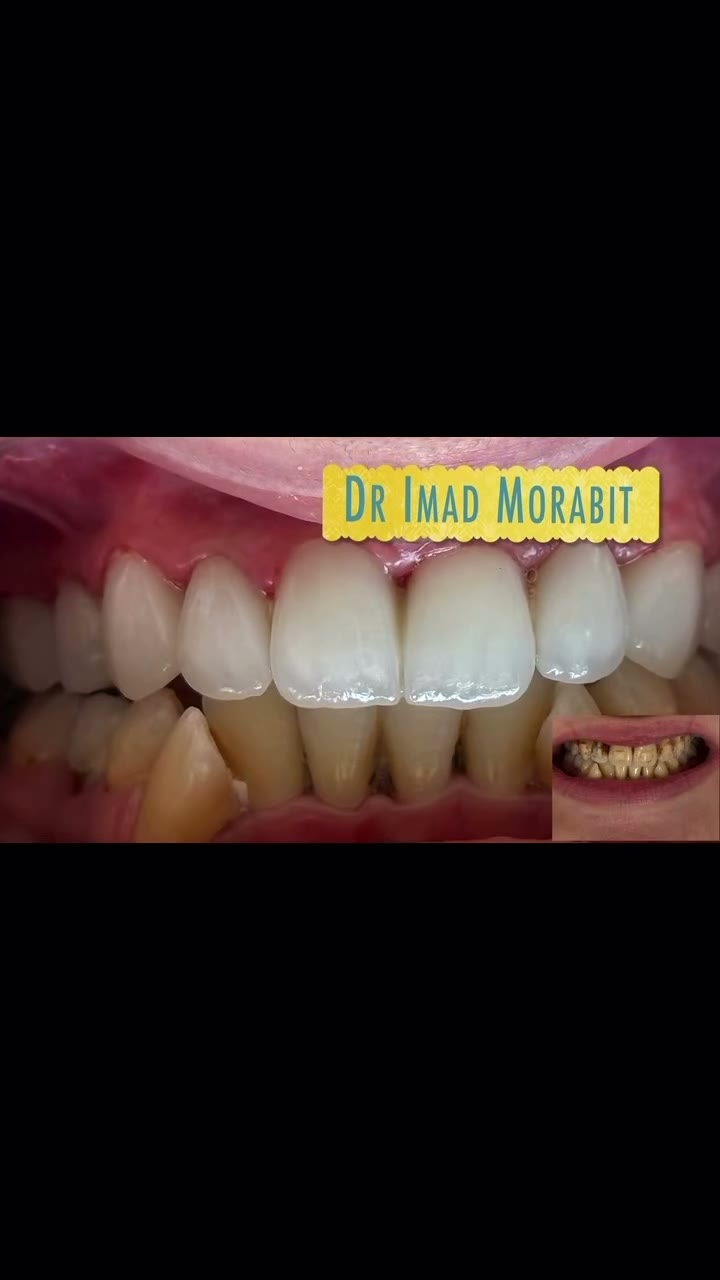 Cas réel Hollywood Smile en vidéo