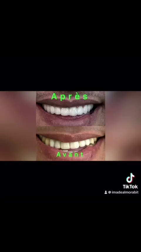 Cas réel Hollywood Smile en vidéo