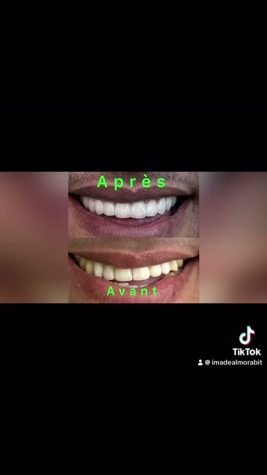 Cas réel Hollywood Smile en vidéo