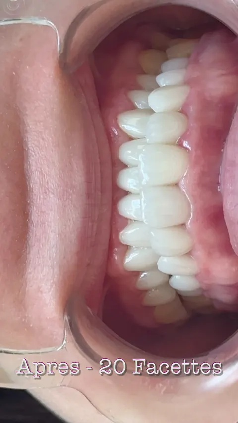 Cas réel Hollywood Smile en vidéo
